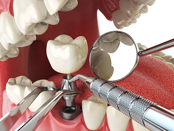 Best Emergency Broken Tooth Repair in Nicollet, MN
